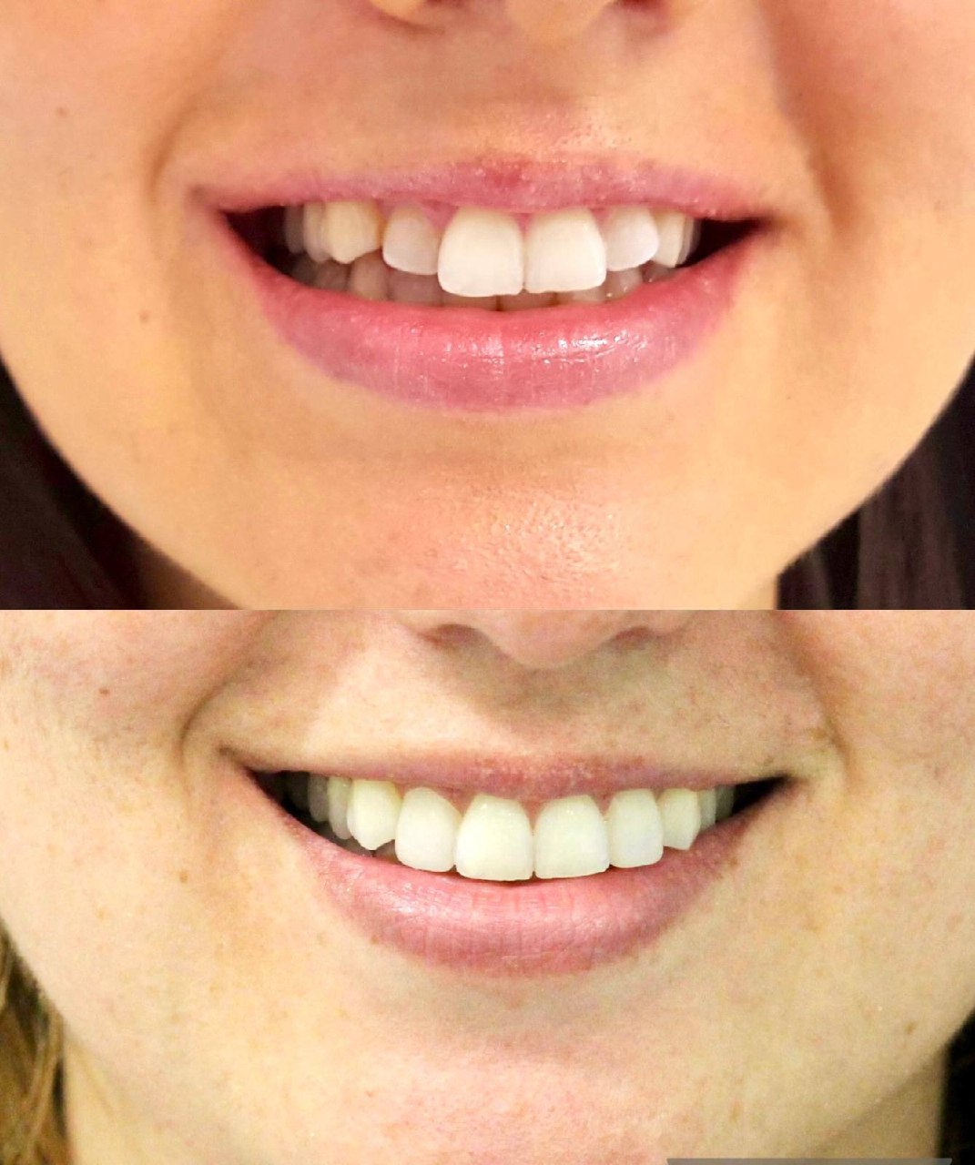 Before and after smile transformation - Invisalign treatment by Dr Jasleen Sandhu